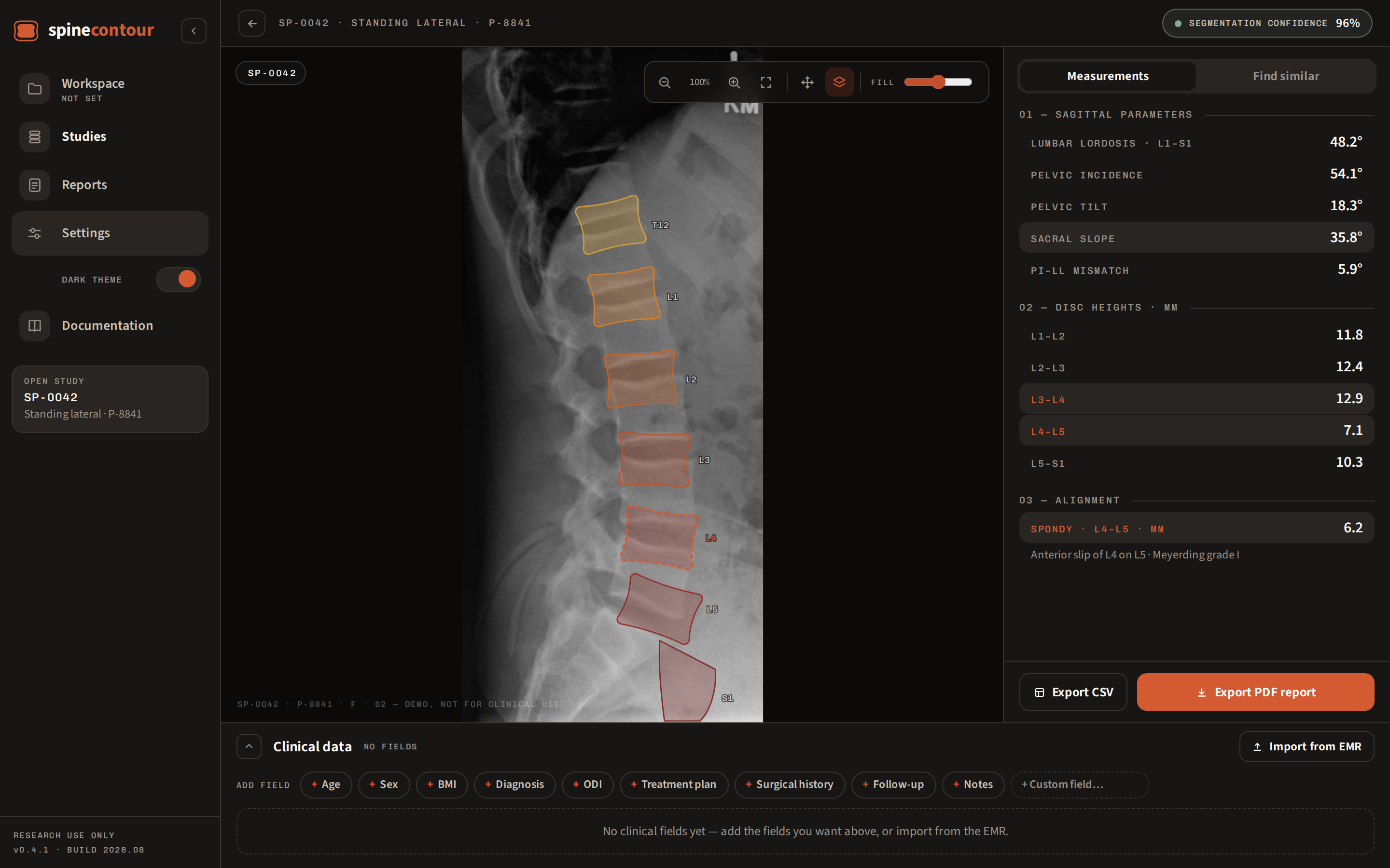 SpineContour study analysis in dark mode: lateral radiograph with per-vertebra segmentation overlays and sagittal measurements panel