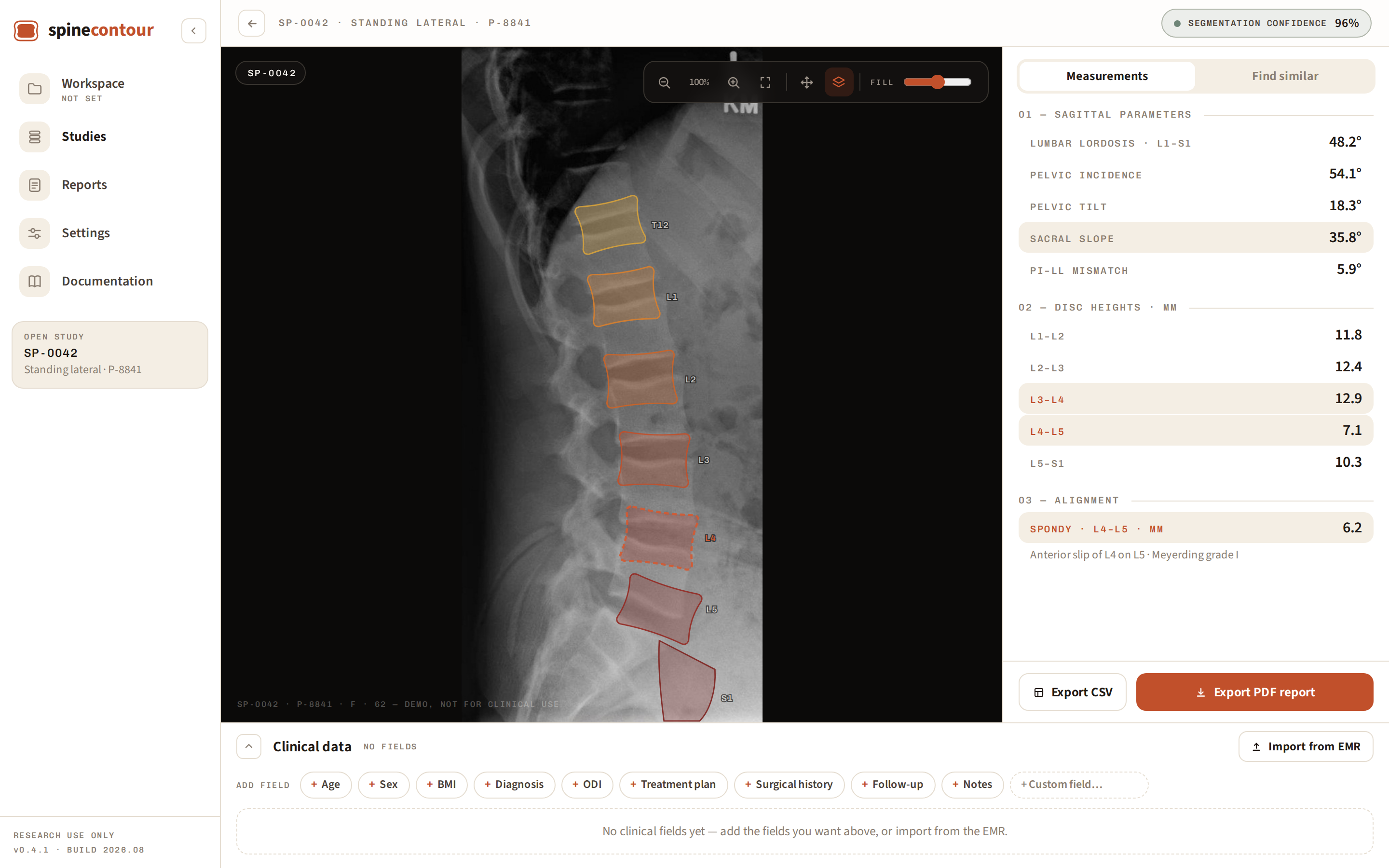 SpineContour study analysis: lateral radiograph with per-vertebra segmentation overlays and sagittal measurements panel